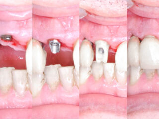 https://cianiconsultorios.com.ar/wp-content/uploads/2021/09/Implante-Dental-320x240.jpg